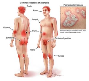 types_psoriases1