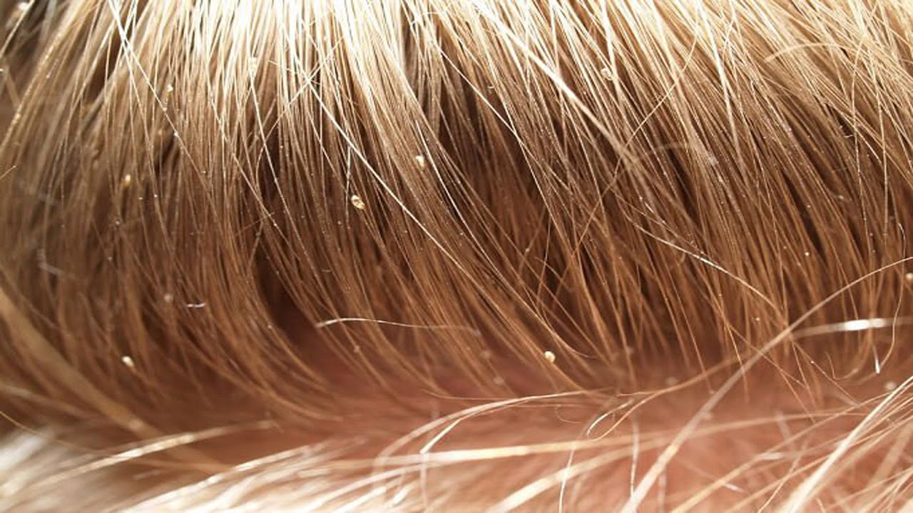 head lice vs dandruff pictures