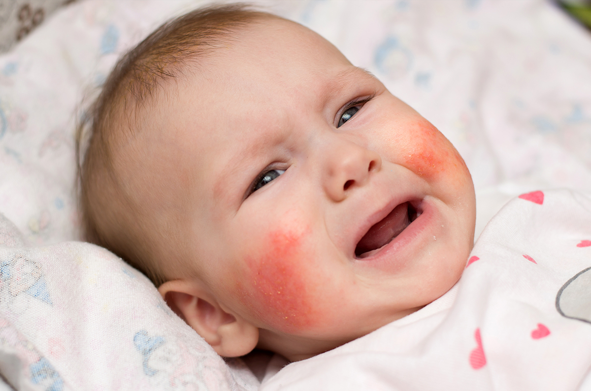 This image portrays Eczema / Dermatitis by Knoxville Institute of Dermatology.