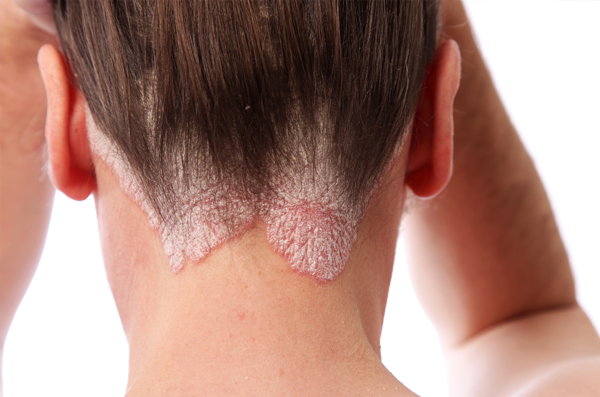 This image portrays August is National Psoriasis Month by Knoxville Institute of Dermatology.