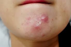 This image portrays Deep Painful Pimples by Knoxville Institute of Dermatology.