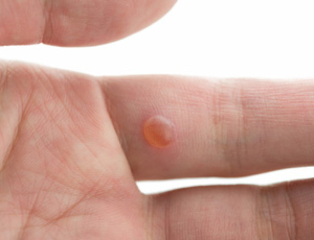 Protecting Babies from Eczema Knoxville Institute of Dermatology