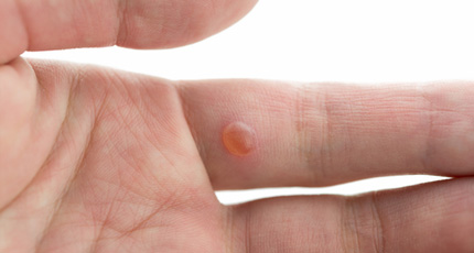This image portrays July: Wart Awareness Month by Knoxville Institute of Dermatology.